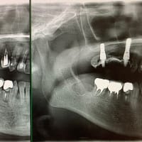 気持ちの悪い上顎入れ歯から快適な固定式の仮歯にインプラントでできます！骨造りも一緒にしてます。