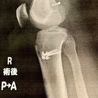 ACL 前十字靭帯再建術　次男君のオペ