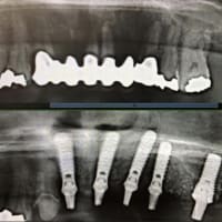 歯周病で抜歯から直ぐにインプラントで骨造成して、次の日腫れも痛みも殆どありません。