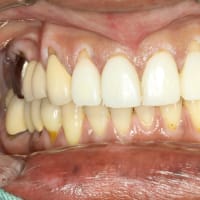 歯ぐきの再生治療はもうご存知でしょうか？　歯茎が下がったときの治療法です．