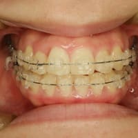 矯正治療をお考えの方歯茎が下がる予防についてはお考えですか？