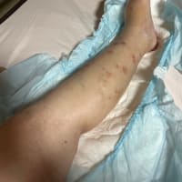 【祖母の現状】滲出液と腹痛および認知症の進行