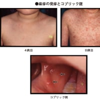 コロナワクチン接種によって免疫力を失った20代男性が麻疹に感染、京都から奈良に移動。
