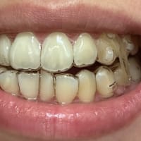 【歯科矯正】１週間して感じたこととメリット＆デメリット