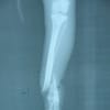 うさぎの脛骨骨折整復術
