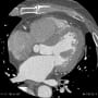 atrial circumflex branch