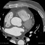 sinus node branch (LCX)