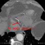 posterior descending branch