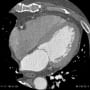 posterolateral branch