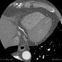 posterior descending branch (LCX, 15PD)