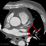 septal branch