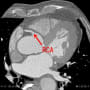 sinus node branch (RCA)