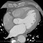 right ventricular branch