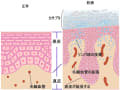 大阪・漢方　『乾癬（尋常性乾癬）』とは