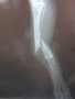 うさぎの脛骨遠位端骨折のレントゲン