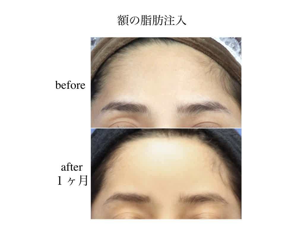 丸い額に 脂肪注入 1ヶ月後 厚木で美しく 丸い額に 脂肪注入 1ヶ月後 厚木で美しく