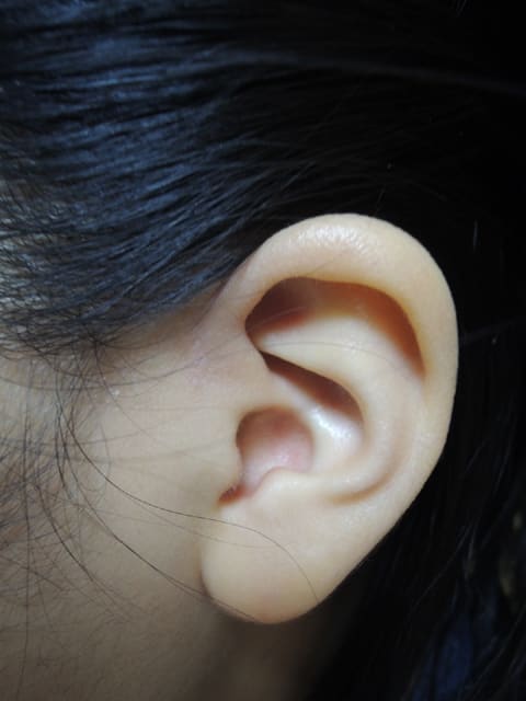 先天性耳瘻孔 手術後２年 サバ奈子