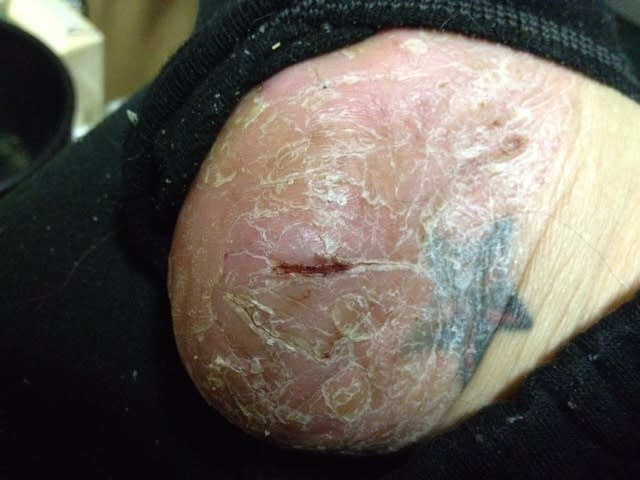 久々のパックリ割れ 果てなき闘い 掌蹠膿疱症 難治性皮膚疾患
