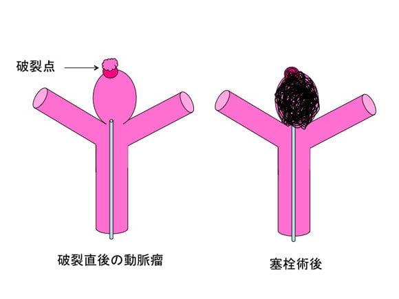 破裂脳動脈瘤のコイル塞栓術 脳卒中をやっつけろ