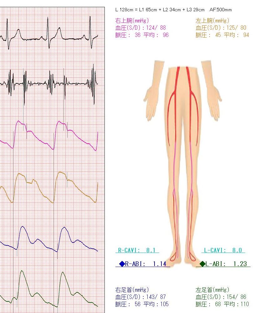血圧の左右差のその後 Halクリニックの診察室から