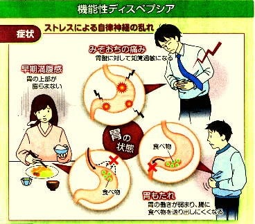 機能性ディスペプシアの症状