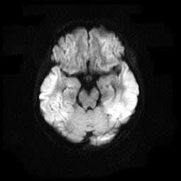 低酸素脳症の画像 なんでも内科診療日誌