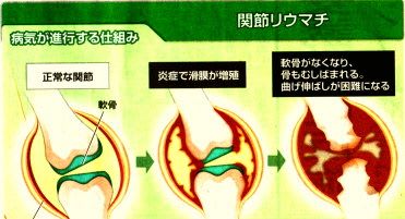 関節リウマチが進行する仕組み