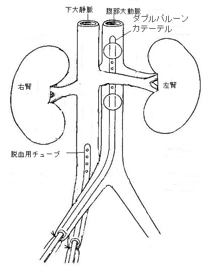 挿入されたダブルバルーンカテーテル