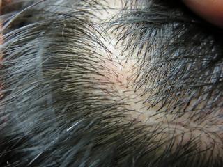 回復 症 期 脱毛 円形 【体験談】円形脱毛症が治るときの兆候とは？どんな事が起きるのか