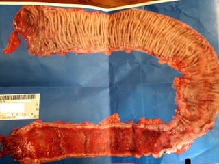 閲覧注意 摘出した大腸の写真 かおぽんと潰瘍性大腸炎の上手なつきあいかた 閲覧注意 摘出した大腸の写真 かおぽんと潰瘍性大腸炎の上手なつきあいかた