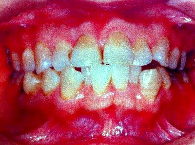 歯列矯正ビフォーアフター 45歳からの歯列矯正 Ch 写真共有 Goo Blog フォトチャンネル