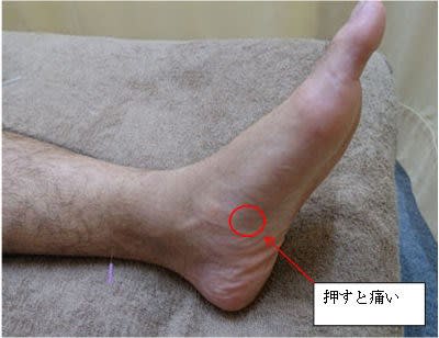 踵 かかと 寄りの土踏まずのところを押すと痛い 3 25臨床実践塾の準備 ハリックの診断即治療 虹彩と Kenさんの経済学 スケッチ