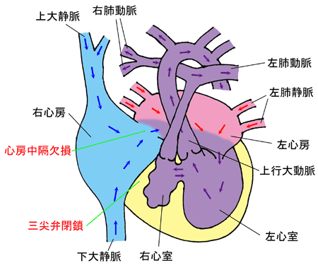 三尖弁閉鎖症（TA） - ある産婦人科医のひとりごと