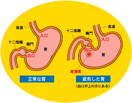 胃幽門狭窄症 4 かんにんブクロ