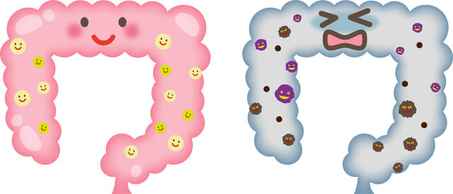 大腸がんの手術