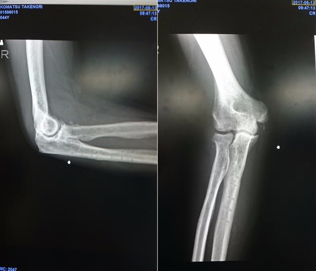右肘関節脱臼骨折の拘縮 何しろ１日１投稿がモットーの瓦版ブログです