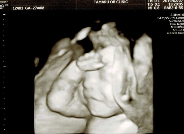 超音波検査は妊娠中期が写りが良いのです タマルさんはナツメヤシ