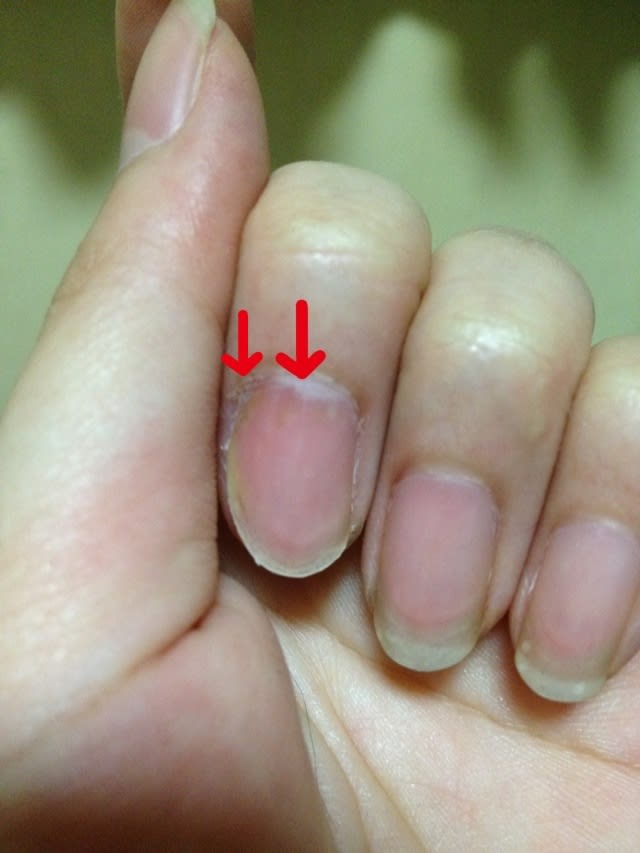 12年3月のブログ記事一覧 果てなき闘い 掌蹠膿疱症 難治性皮膚疾患