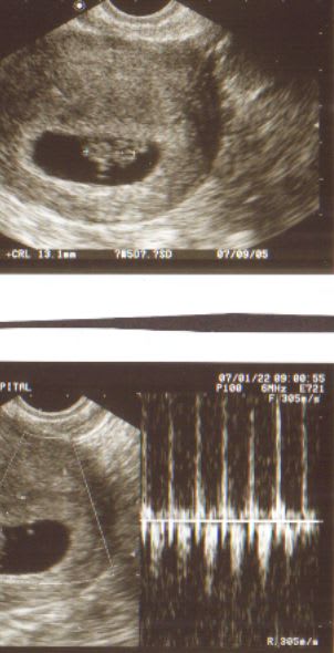 1 3cmの赤ちゃん 心臓もバクバク 日本人が知らない世界と日々の生活 1 3cmの赤ちゃん 心臓もバクバク 日本人が知らない世界と日々の生活