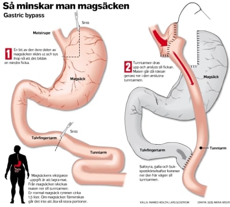超肥満のための最後の手段 胃のバイパス手術 スウェーデンの今