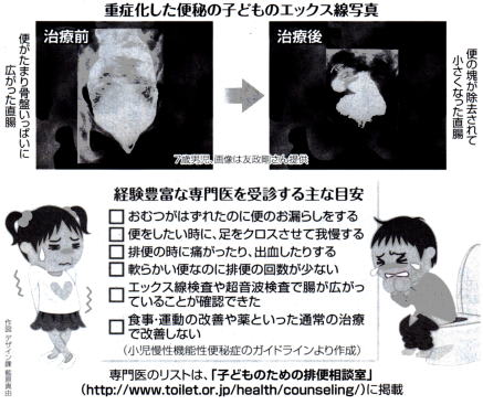 重症化した便秘の子供のエックス線写真＆受診の目安