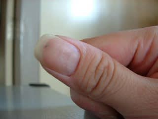 指 トゲ 埋まっ てる 指にトゲが刺さって取れない 放置して大丈夫 抜き方や病院は何科