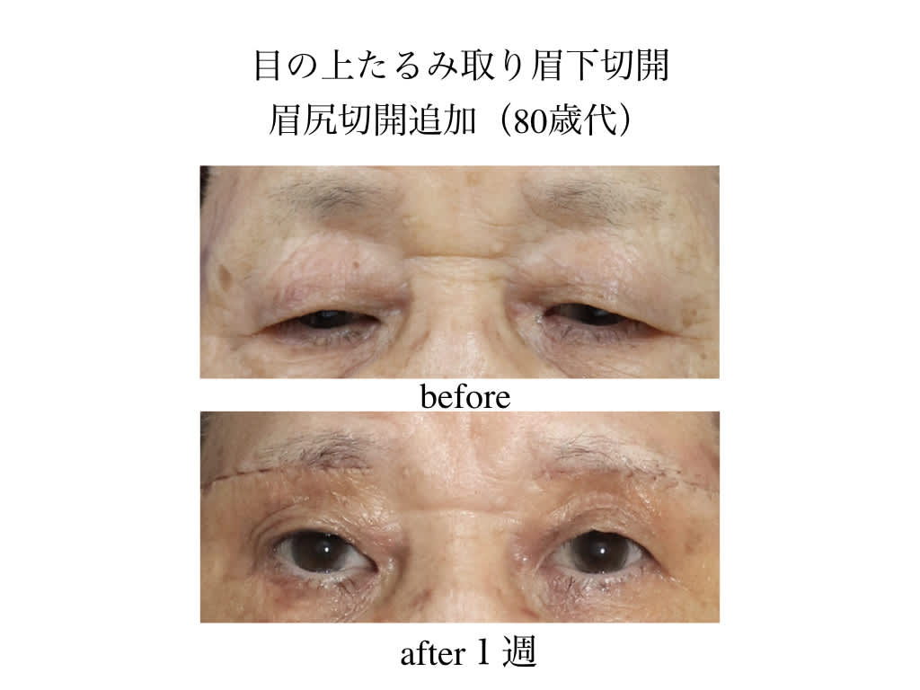 まゆ尻 目の上たるみ取り眉下切開＋眉尻切開 １週後 - 厚木で美しく。