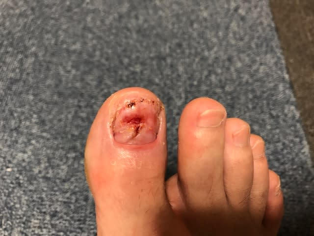 爪を剥がすひと Kaz S Log