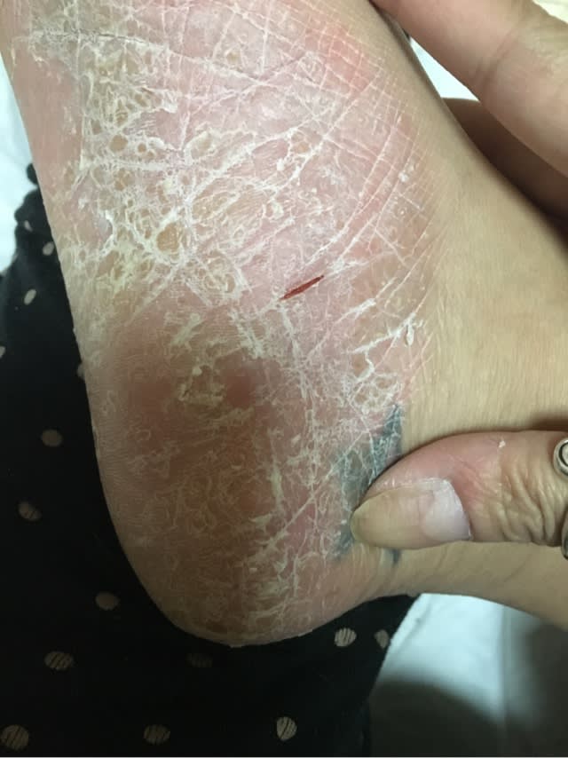 パックリ割れ 果てなき闘い 掌蹠膿疱症 難治性皮膚疾患