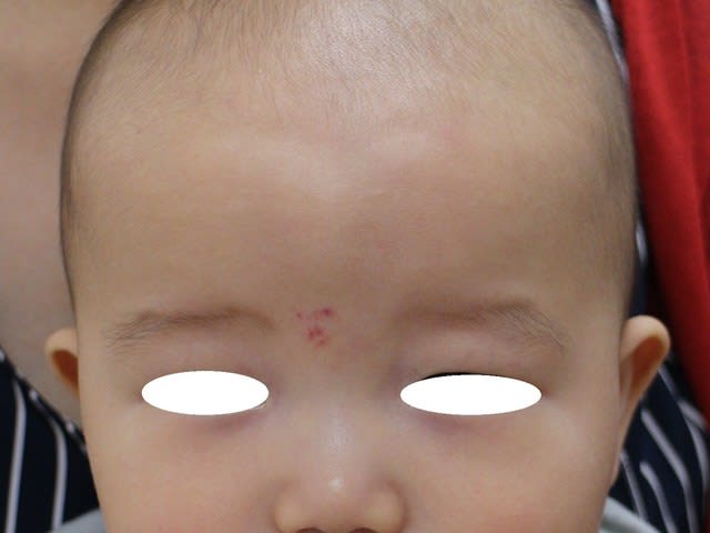 眉間のいちご状血管腫 6か月男の子 ドクターリコの明日もｈａｐｐｙ