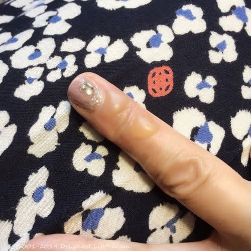 悲しいかな 顔の火傷 レンレンのひとりごと 悲しいかな 顔の火傷 レンレンのひとりごと