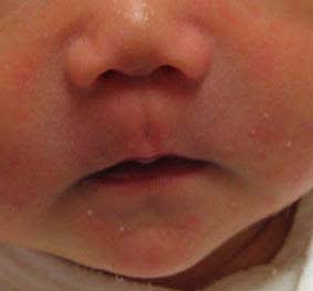 乳児湿疹画像記録 食物アレルギー克服