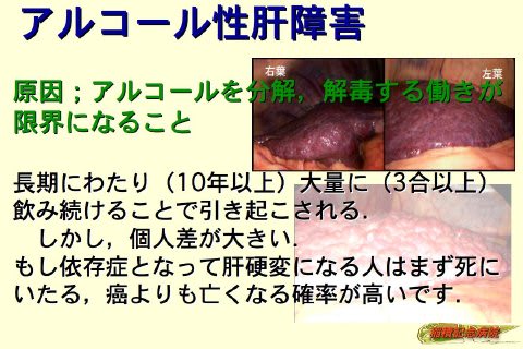 03アルコール性肝障害 生活習慣から来る肝臓病 肝臓病と共に生きる人たちを応援します