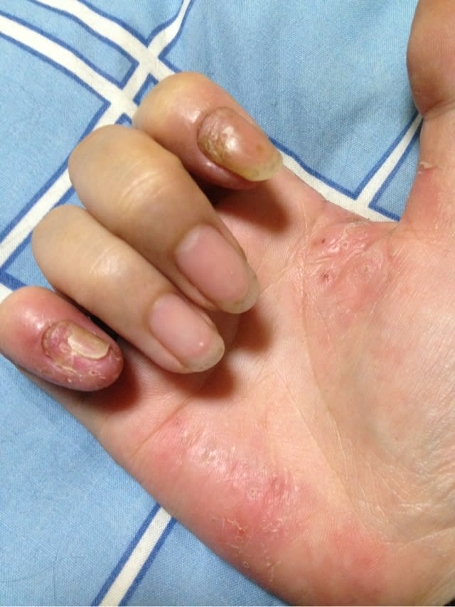 爪剥がれる 果てなき闘い 掌蹠膿疱症 難治性皮膚疾患
